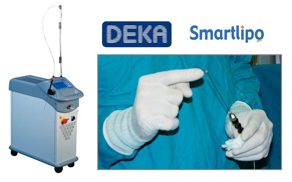 Лазерное лечение гинекомастии на аппарате SmartLipo