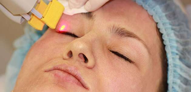 Лазерне омолодження шкіри
